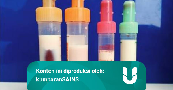Akibat Kebanyakan Lemak, Warna Darah Seorang Pria Berubah Mirip Susu